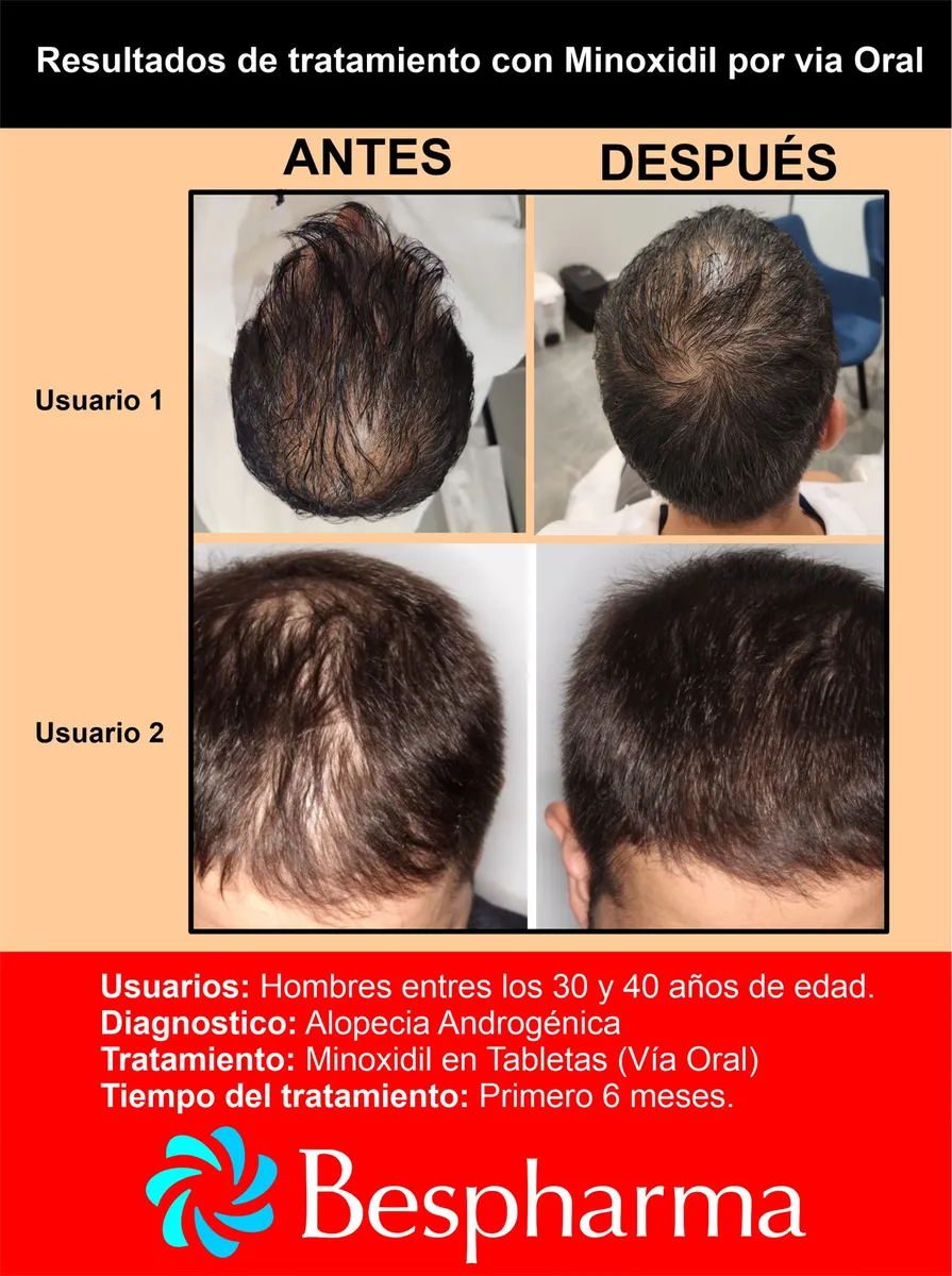 Minoxidil Crecimiento Capilar MINOXITEN SUIPHAR Caja X 30 Tab - Imagen 3